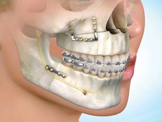 ارتودنسی همراه با جراحی فک